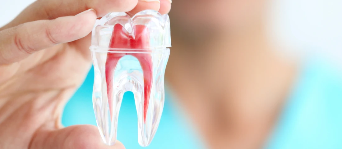 10 популярных вопросов о кариесе и пломбировании каналов зуба